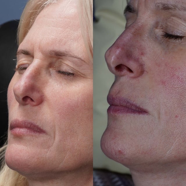 Facial redness and threadvein reduction before and after.