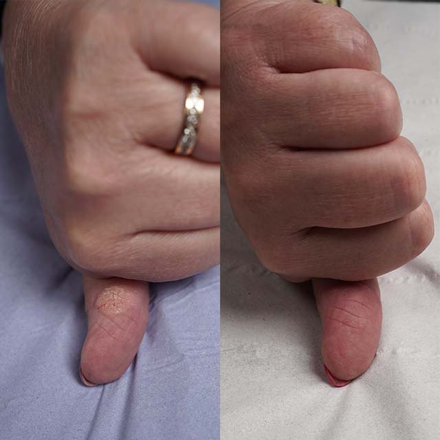 tattoo removal before and after