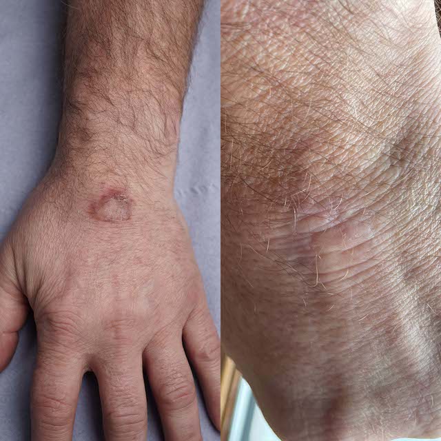 Wart removal before and after