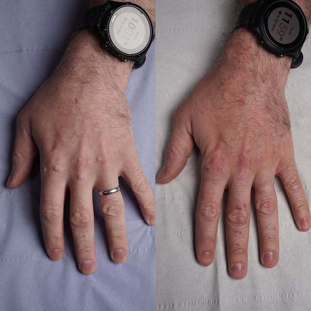 tattoo removal before and after